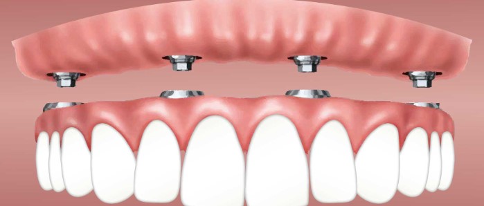 Caring for Your Dental Implants: Tips for Long-Term Success