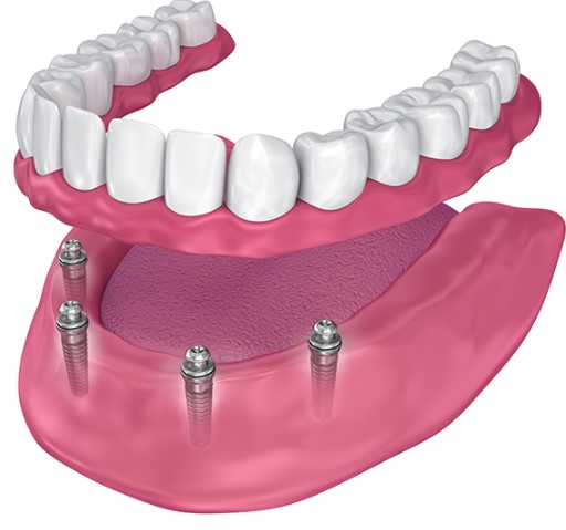 Caring For Your Dental Implants Tips For LongTerm Success, dental implant care, oral implant maintenance, implant success guidelines, longterm oral health, dental restoration tips, implant longevity, oral care practices, implant aftercare, dental hygiene suggestions, dental wellbeing, implant preservation, oral health management, dental support strategies, implant care recommendations, oral hygiene techniques, implant wellness, dental selfcare, oral regimen, implant upkeep, dental advice, oral health insights, dental tips for success, implant health considerations, longlasting oral success
